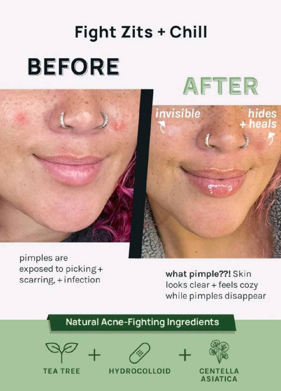 PARCHES PARA ACNE x15