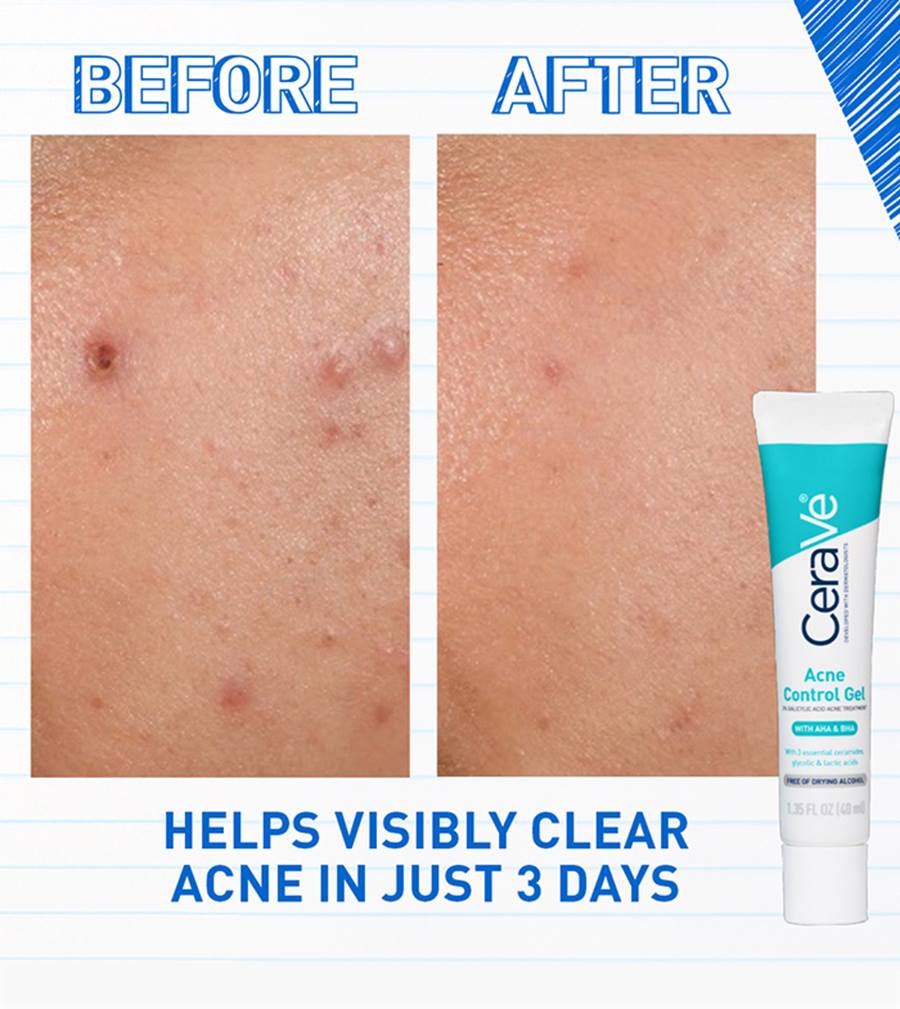 GEL HIDRATANTE FACIAL ACNE CONTROL