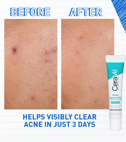 GEL HIDRATANTE FACIAL ACNE CONTROL